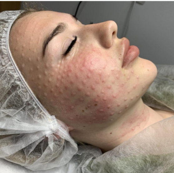 Мезотерапия и биоревитализация