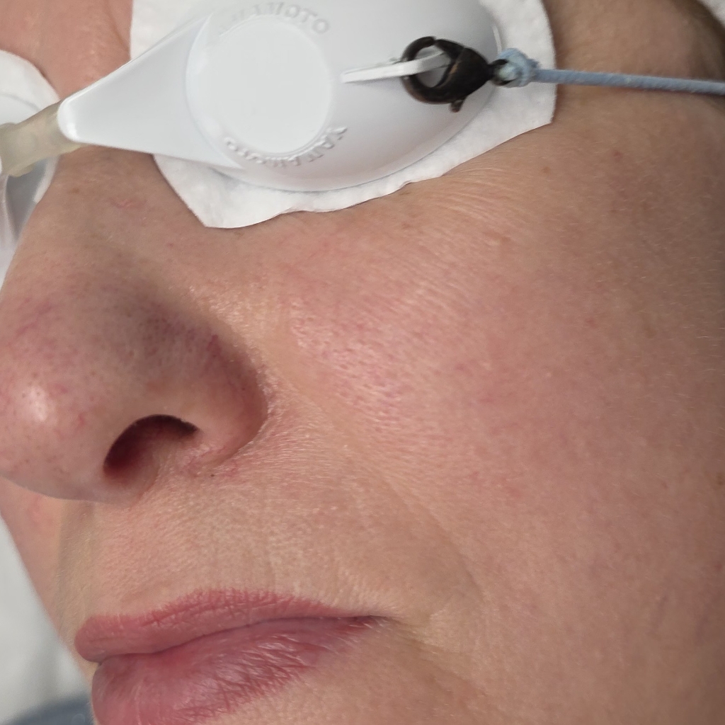 BBL фотоомоложение  1 зона