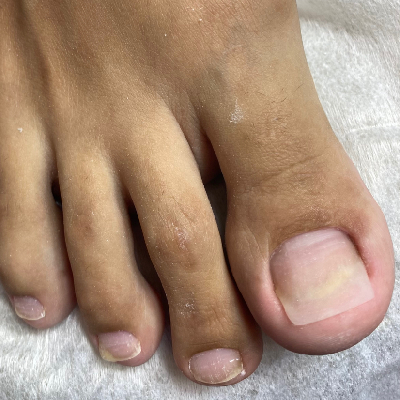 Протезирование онихолизиса