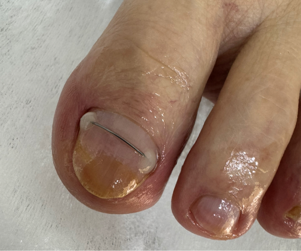 Установка титановой нити