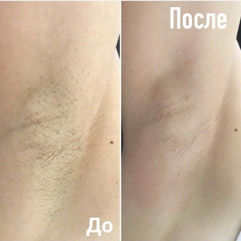 Лазерное удаление
подмышек