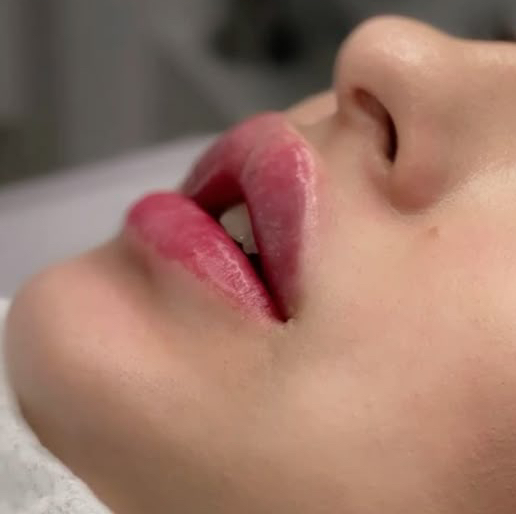 Belotero lips Shape