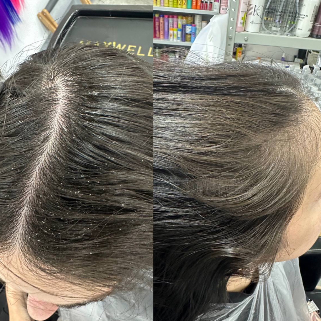 Пилинг кожи головы женский