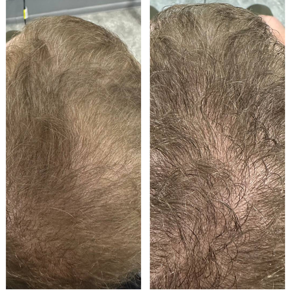 Пилинг кожи головы мужской