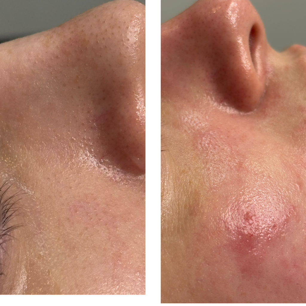 Комбинированная чистка лица + маска