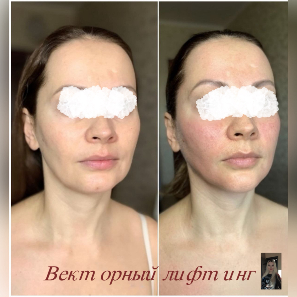 Векторный лифтинг (Гидроксиапатит кальция) 3мл
