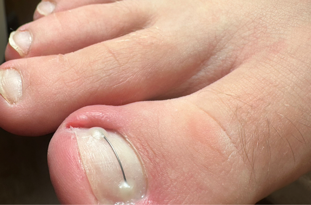 Установка титановой нити