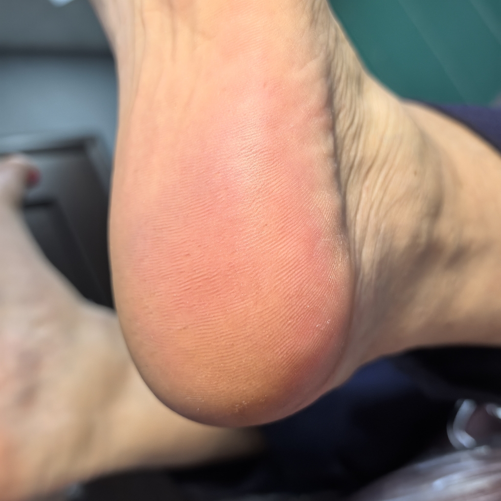 медицинский педикюр