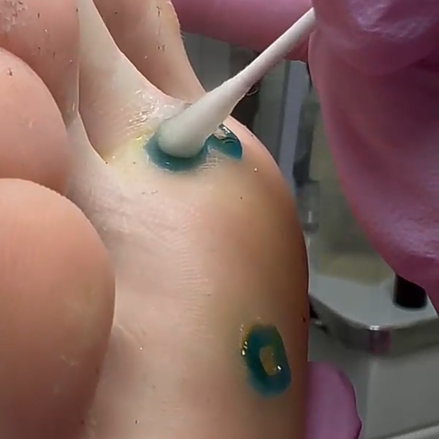 УДАЛЕНИЕ ВПЧ(БОРОДАВКИ)