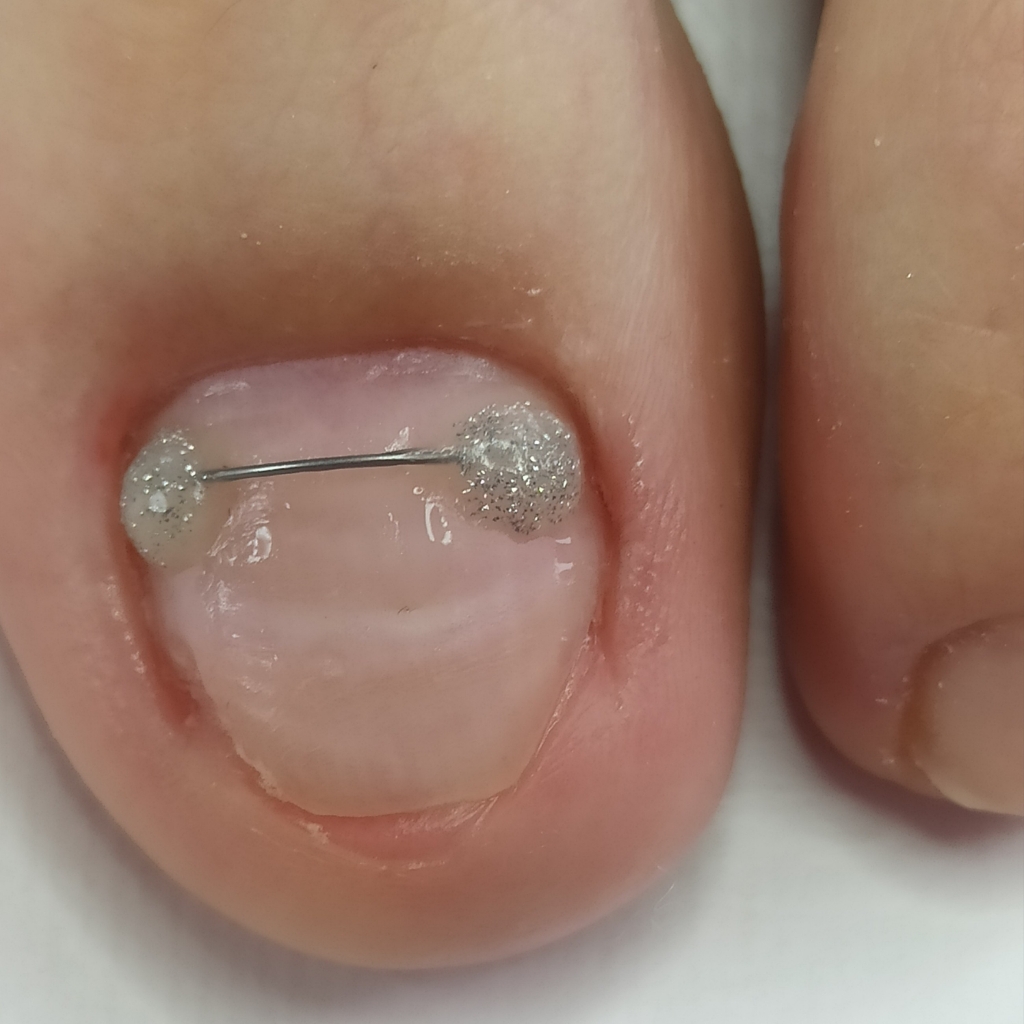 УСТАНОВКА КОРРЕКЦИОННОЙ СИСТЕМЫ (титановая нить)