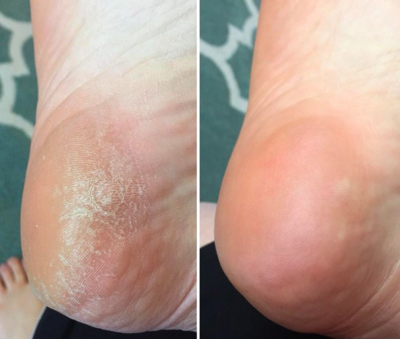 Педикюр ( обработка стоп )