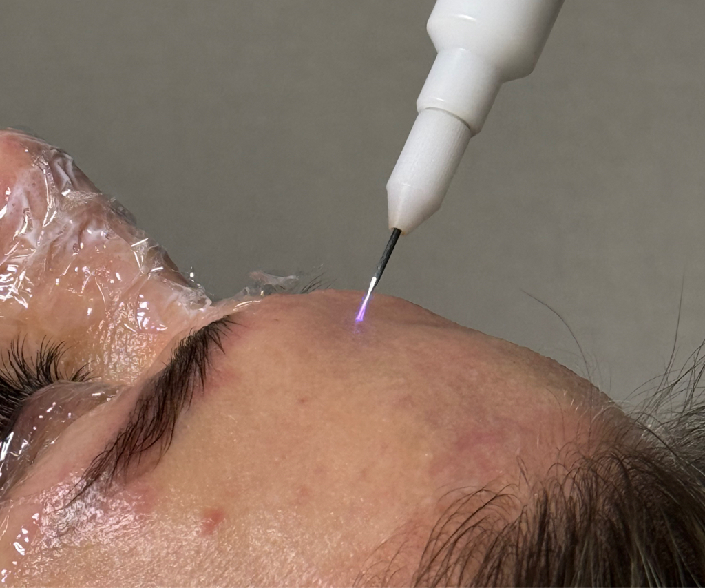 Холодная плазма лица (без обработки зоны верхних и нижних век)