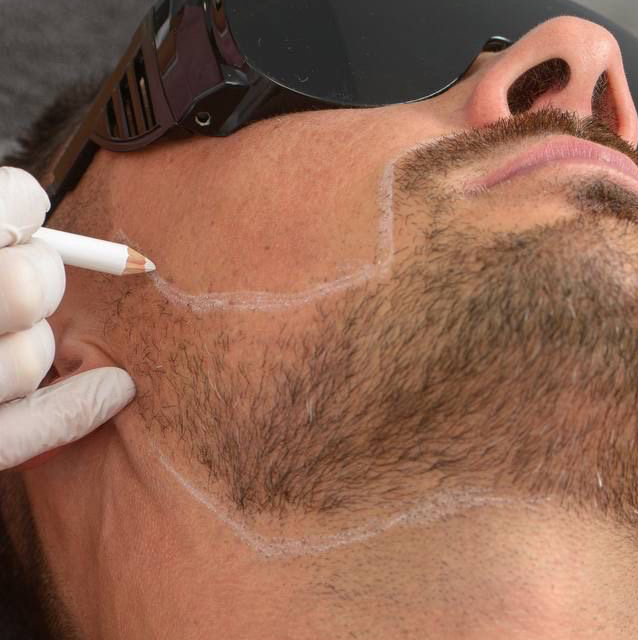 Удаление волос на лице полностью (усики, бакенбарды/подбородок, удаление волос в носу)