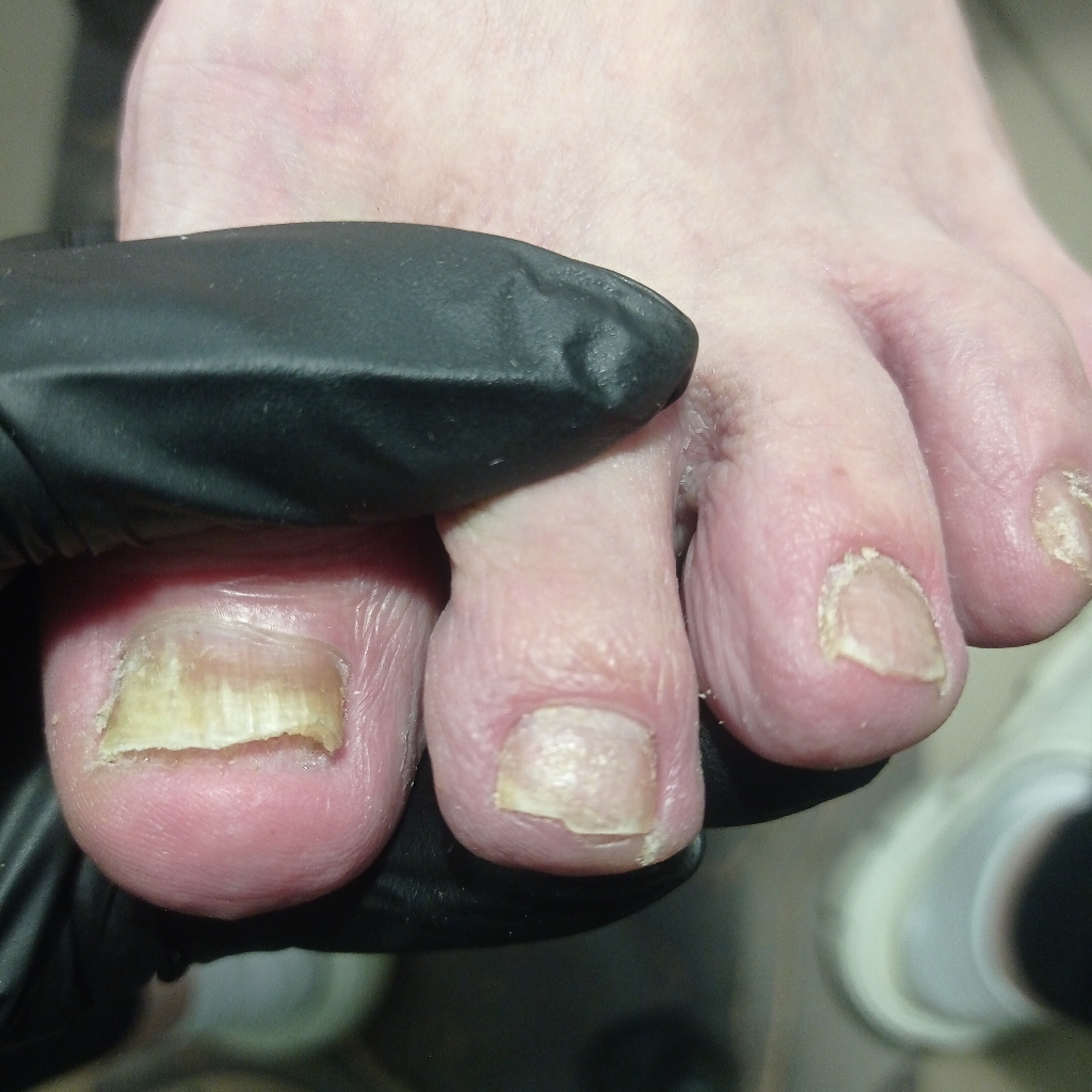 Педикюр. Подообработка всех ногтей и стопы. Псориаз.