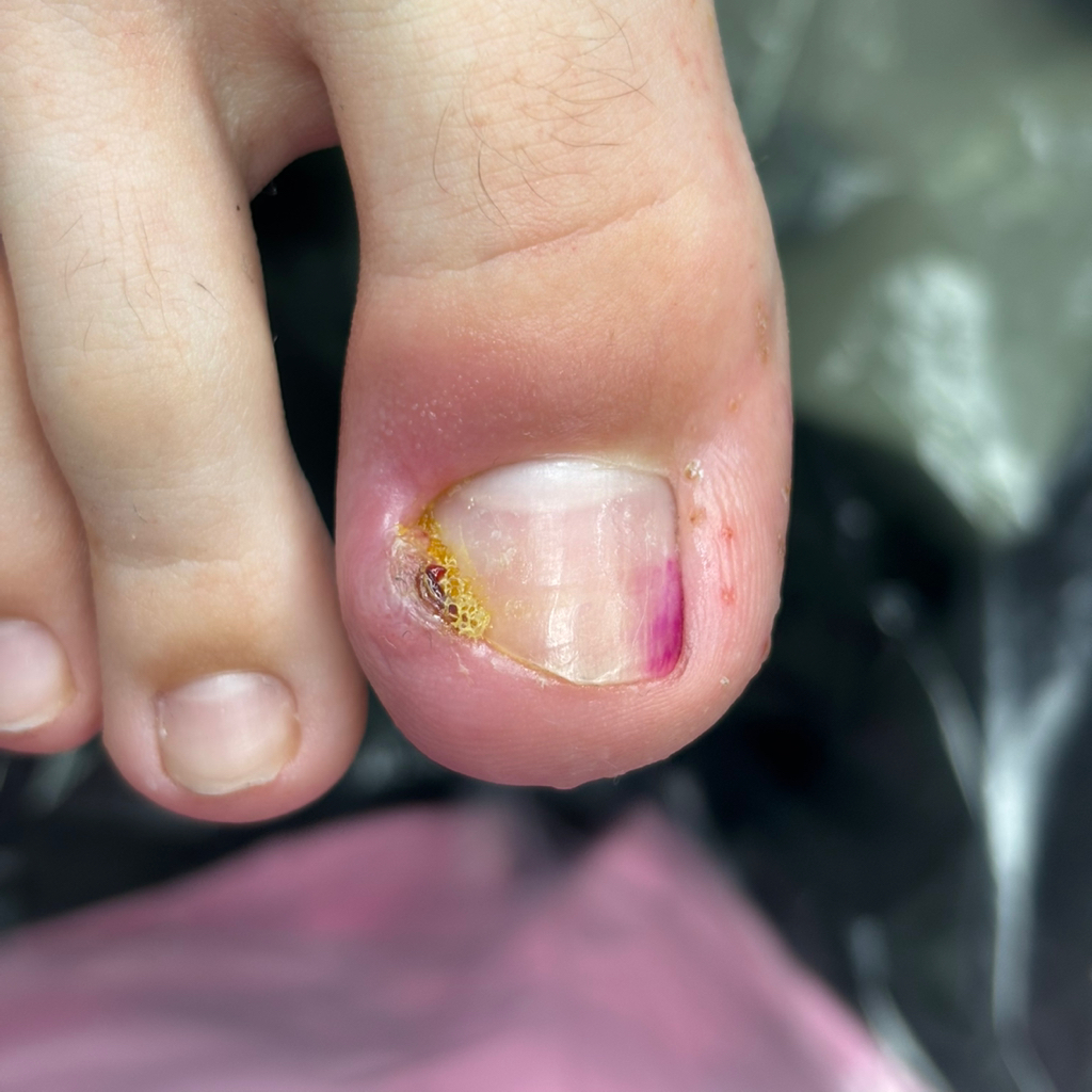 Вросший ноготь