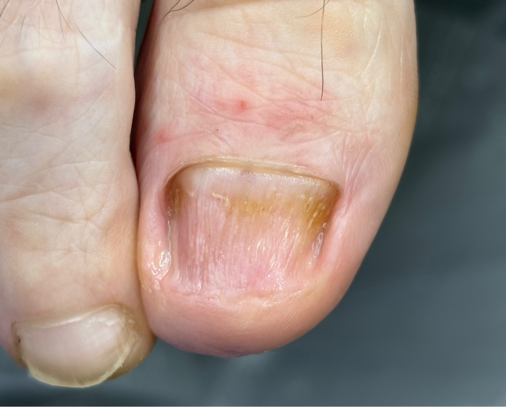 Зачистка грибка (большой палец)