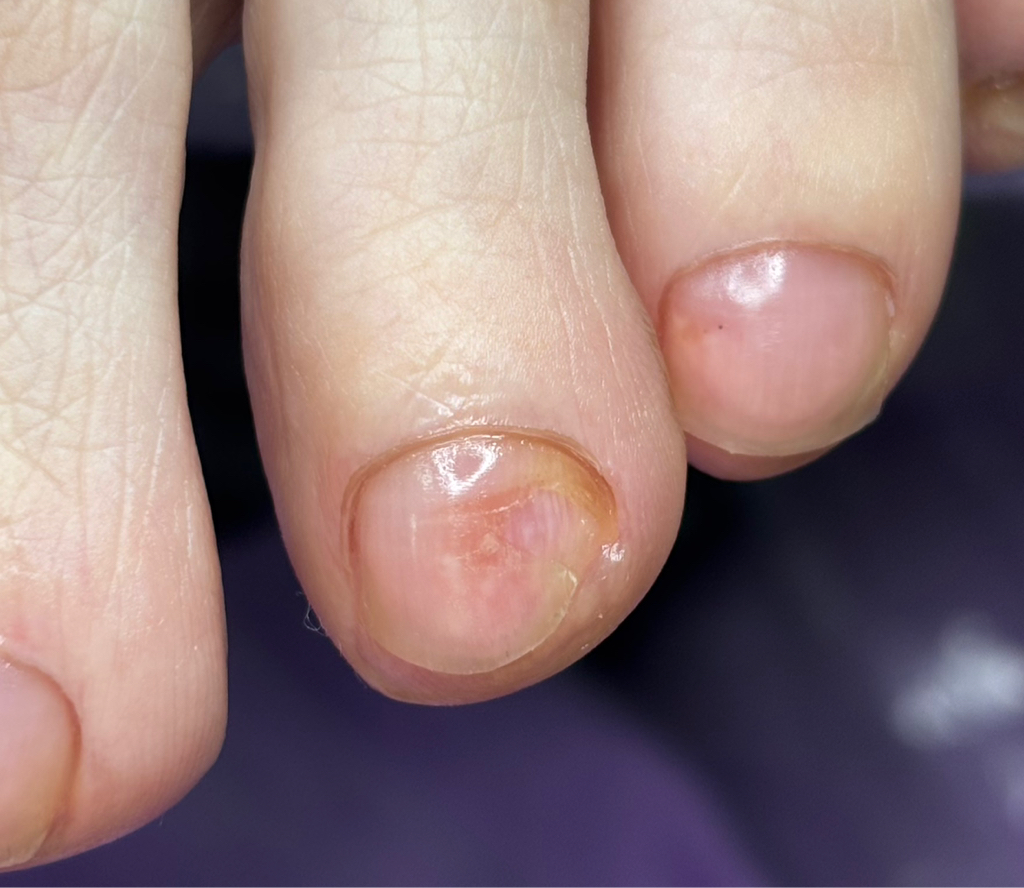 Зачистка 1/3 (маленький палец)