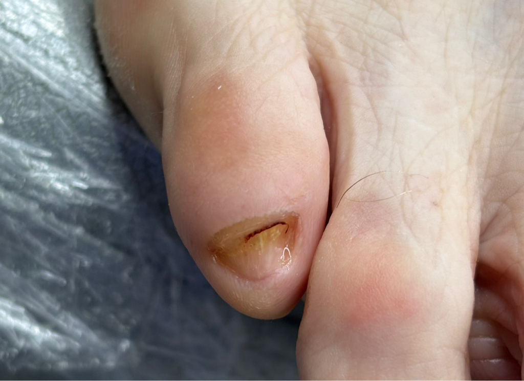 Зачистка грибка (маленький палец)