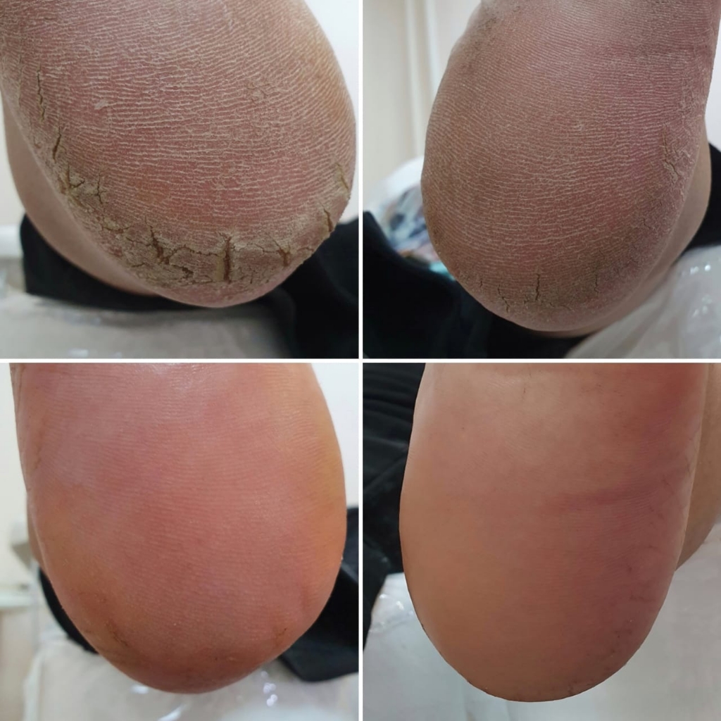 Педикюр (стопы)