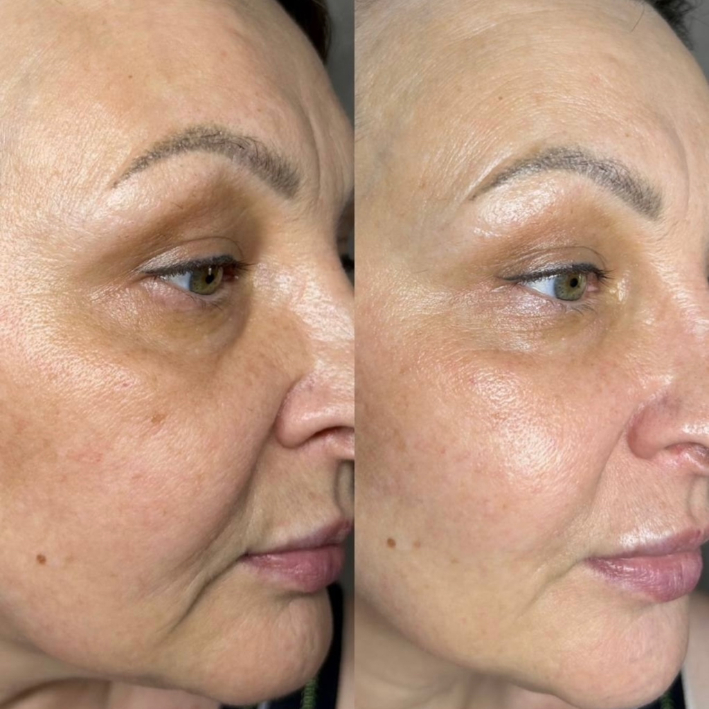 Ферментотерапия- инновационная  процедура для улучшения качества кожи изнутри