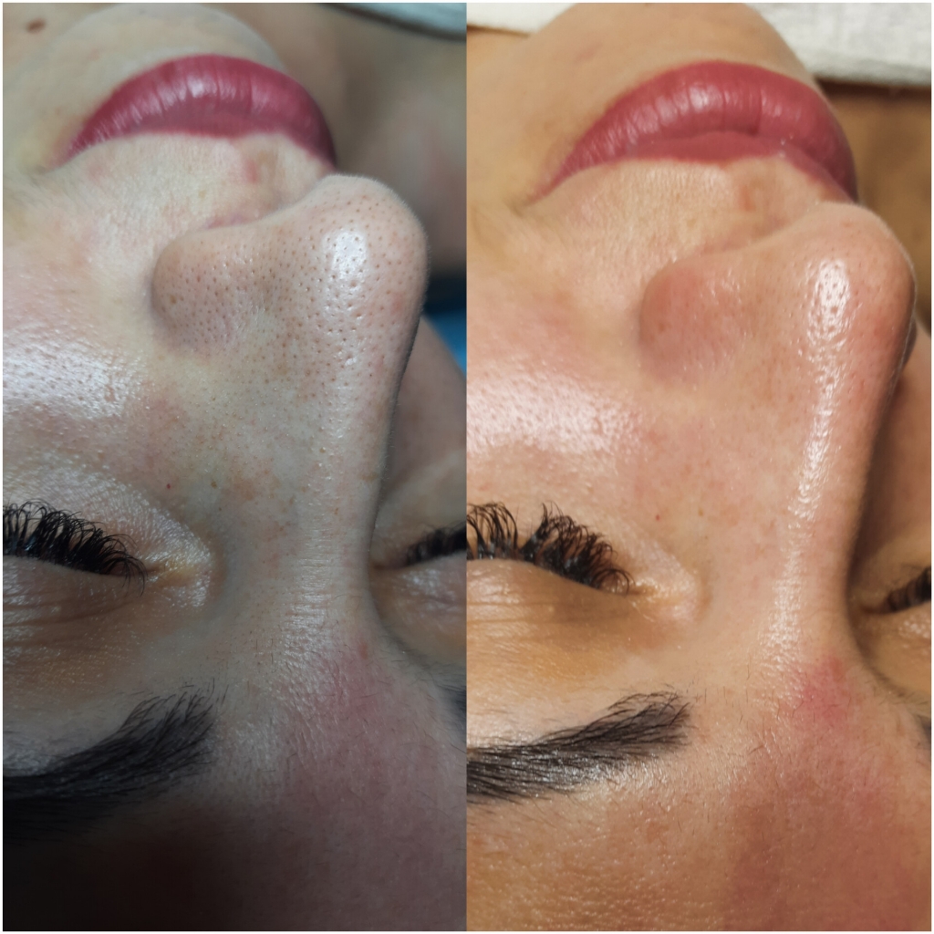 Комбинированная чистка лица