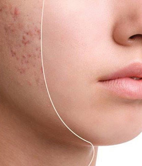 ONmacabim. АКНЕ СТОП, комплекс для проблемной кожи