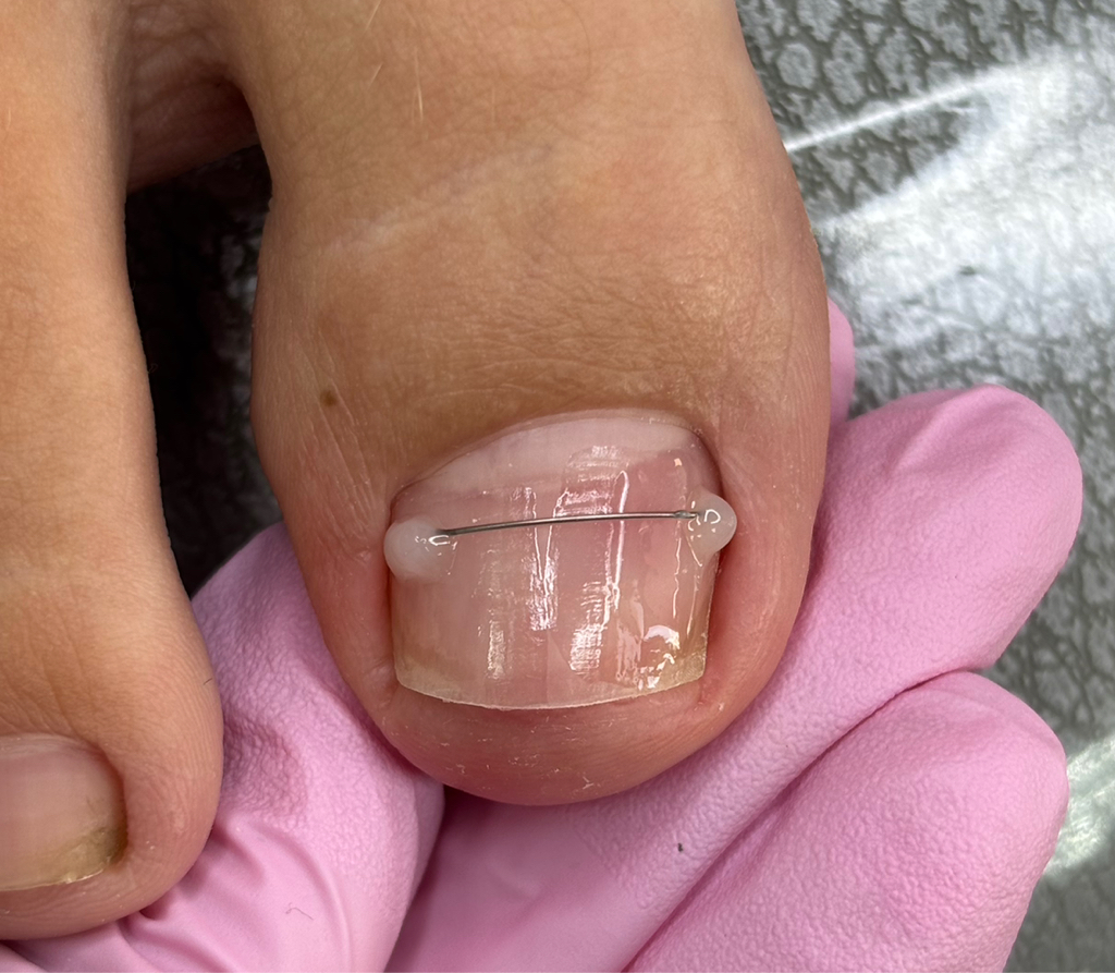 Установка титановой нити(повторный прием)