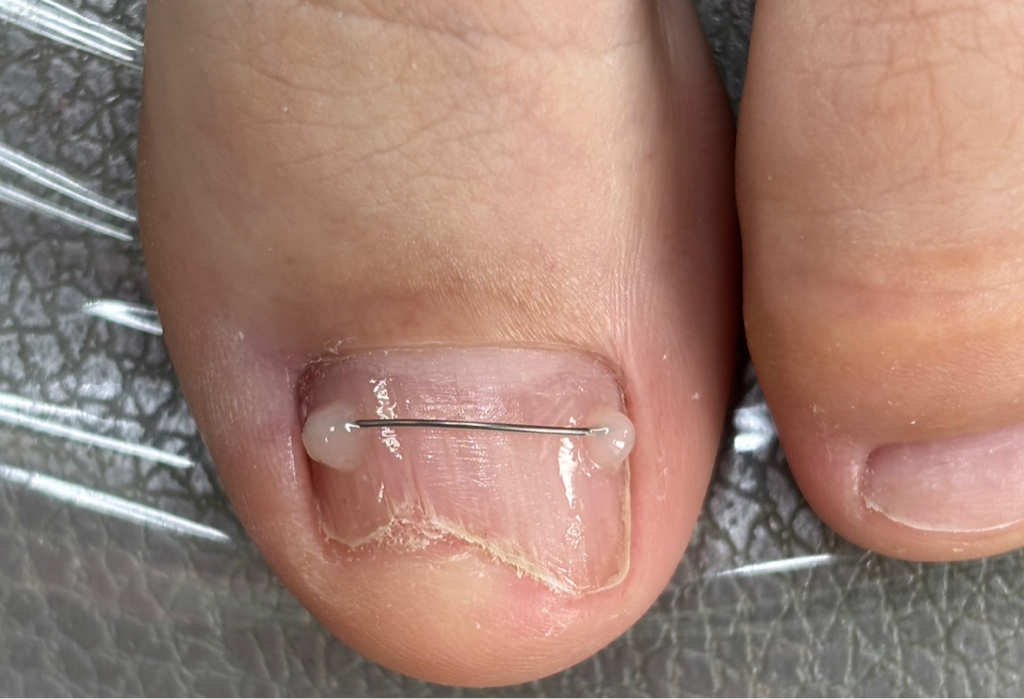 Установка титановой нити