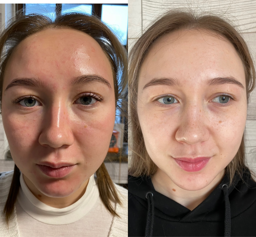 Пилинг мультикислотный