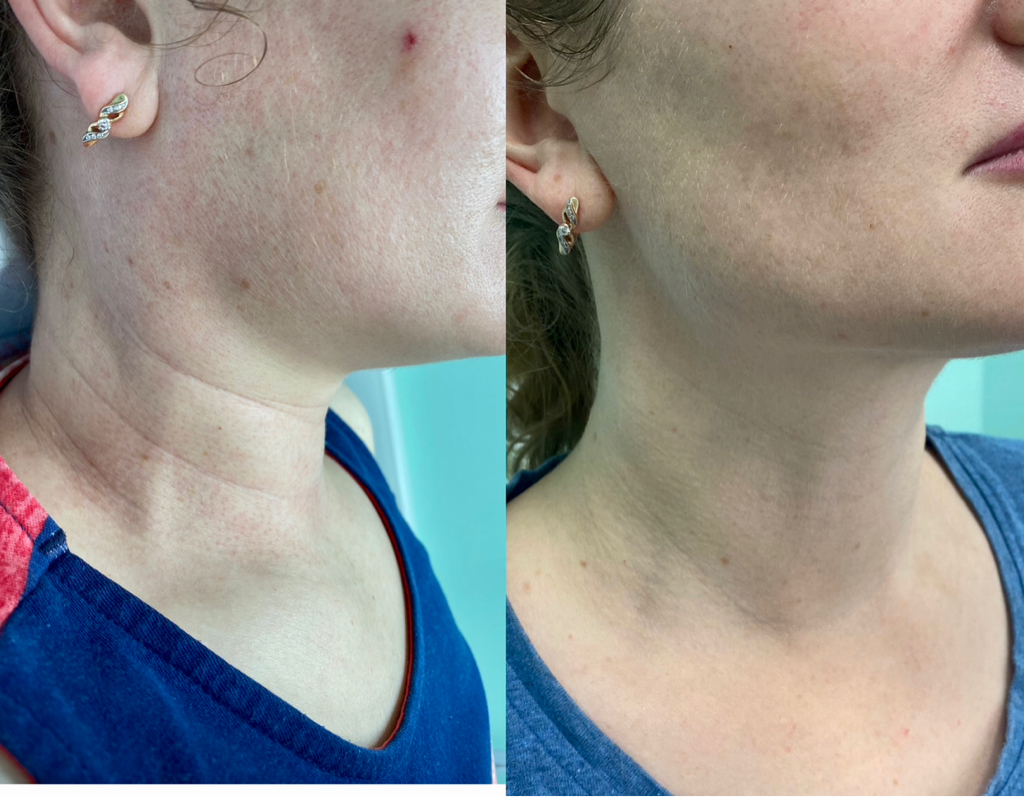 Биоревитализация шеи