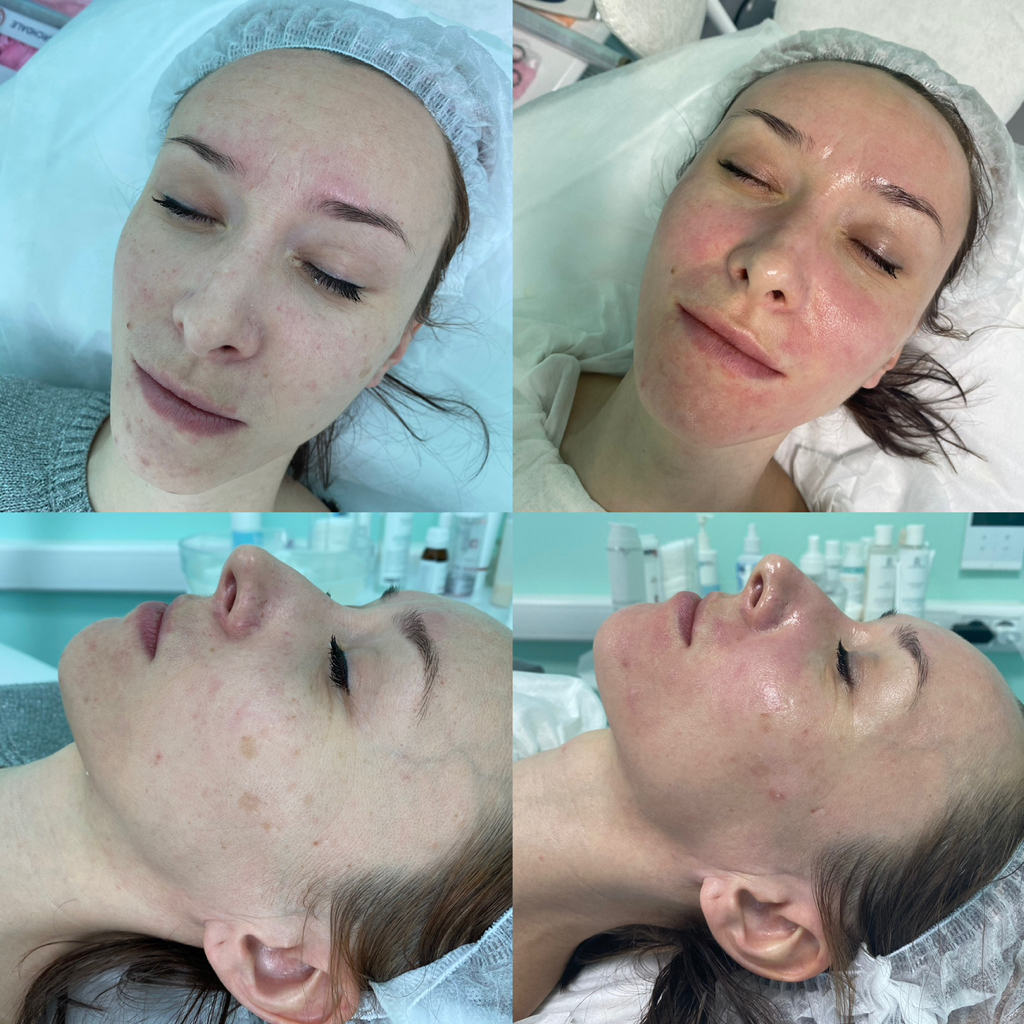 Пилинг «биорепил»