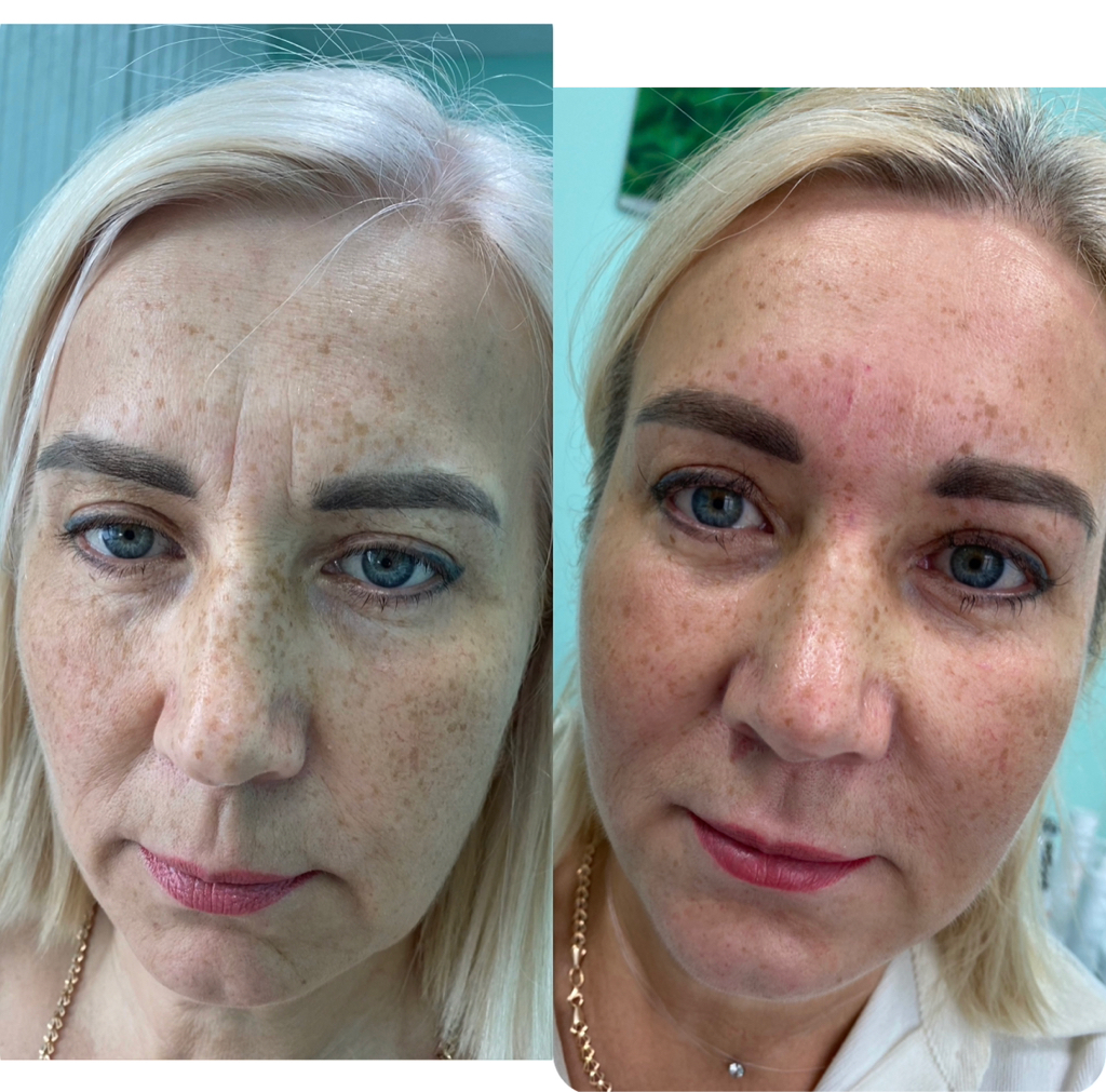 Коррекция статических морщин «Топаз»