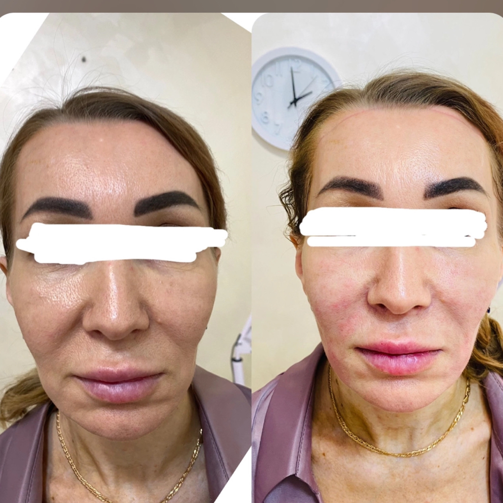 Осмотр коррекция филлера