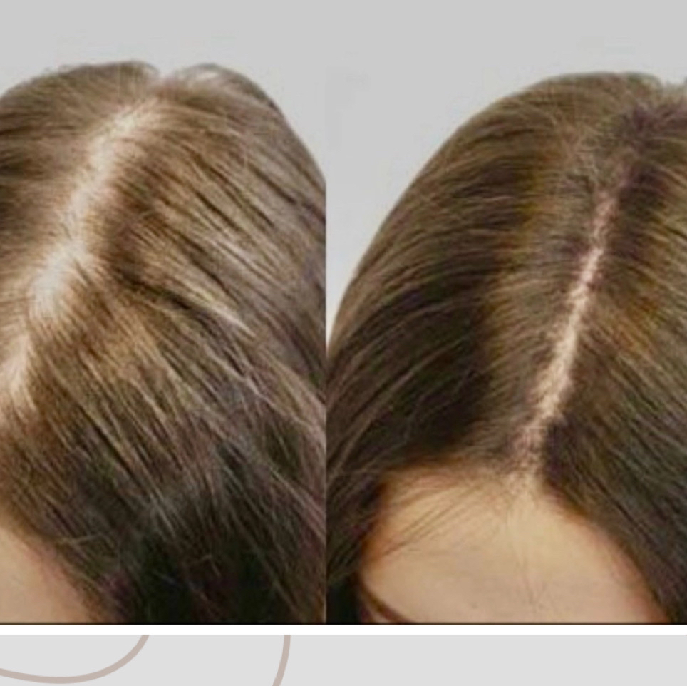 Пилинг кожи головы