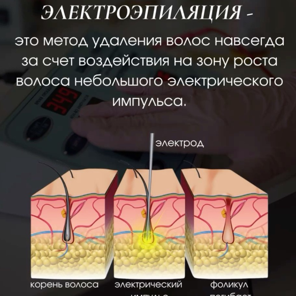Электроэпиляция