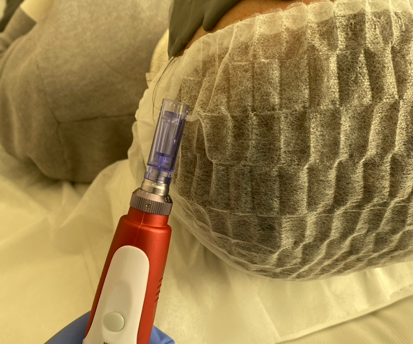 Микронидлинг (фракционная мезотерапия)