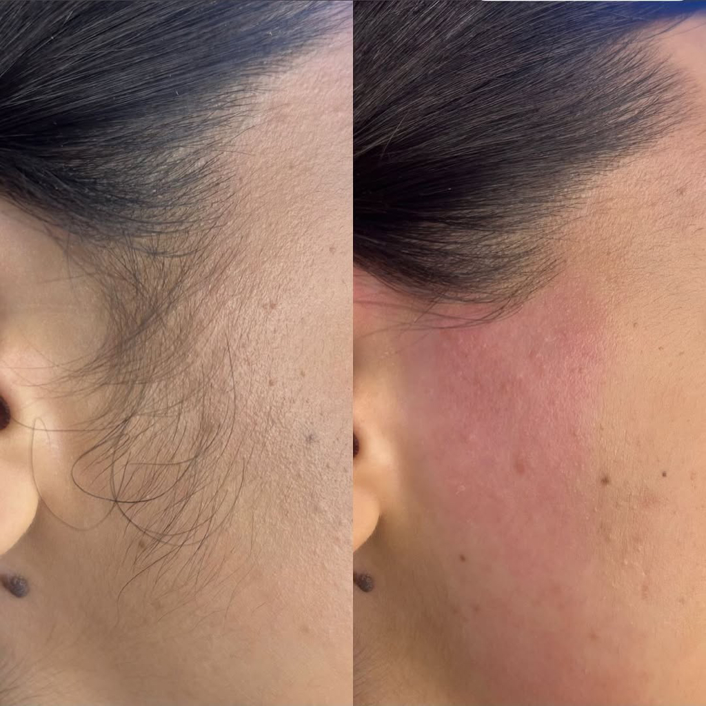 Депиляция лица