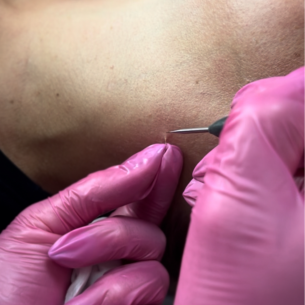 Удаление папиллом (до 3 шт)