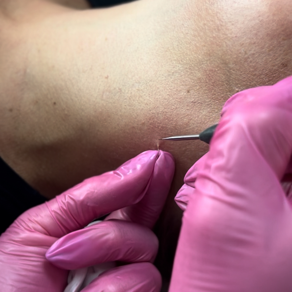 Удаление папиллом ( более 5 шт)