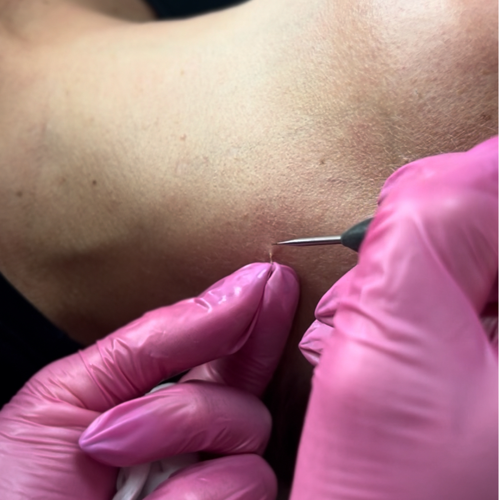 Удаление папиллом (более 3 штук)