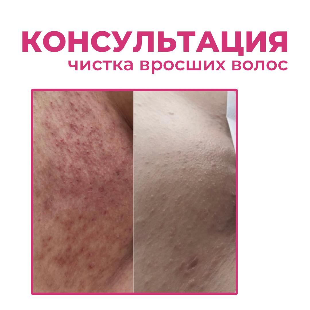 Консультация / Чистка вросших волос