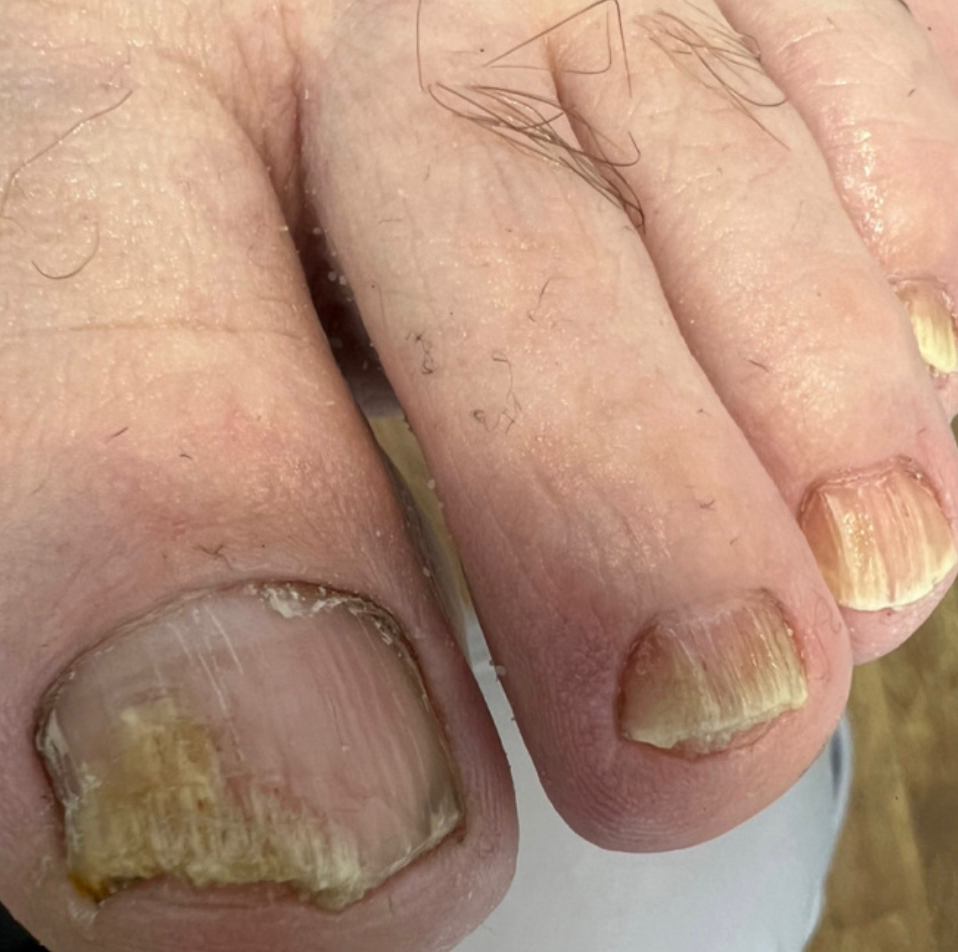 Обработка онихомикоза НП