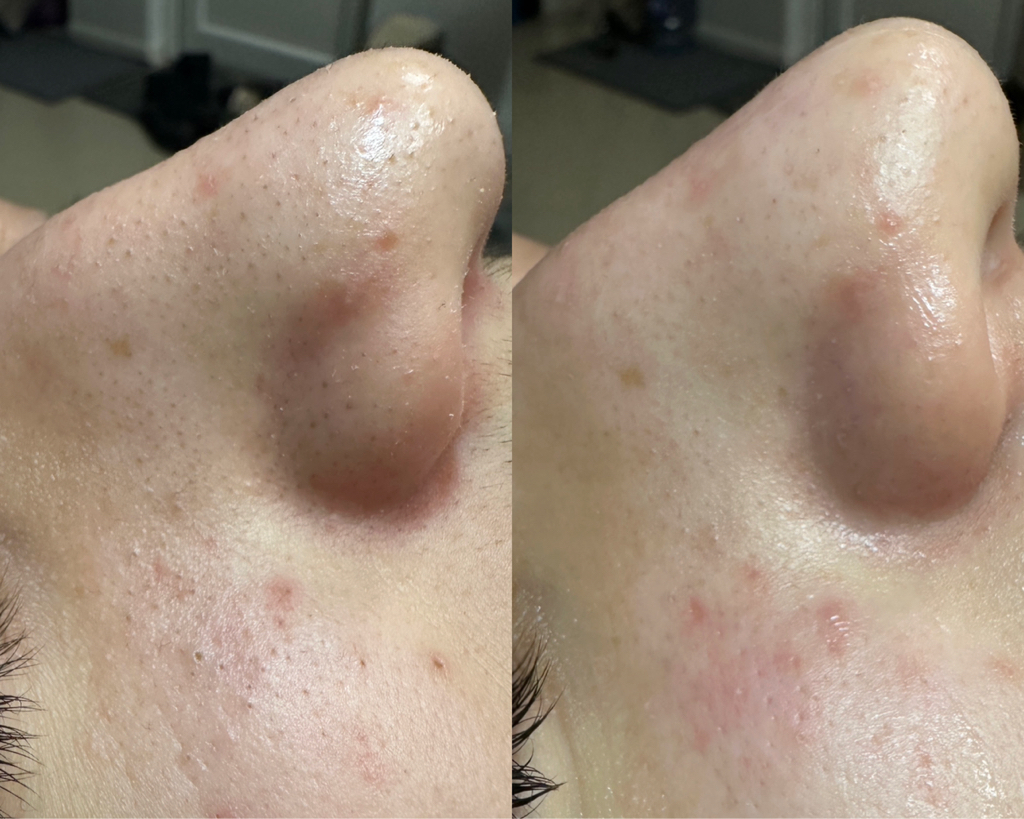 Гидропилинг (HydraFacial)