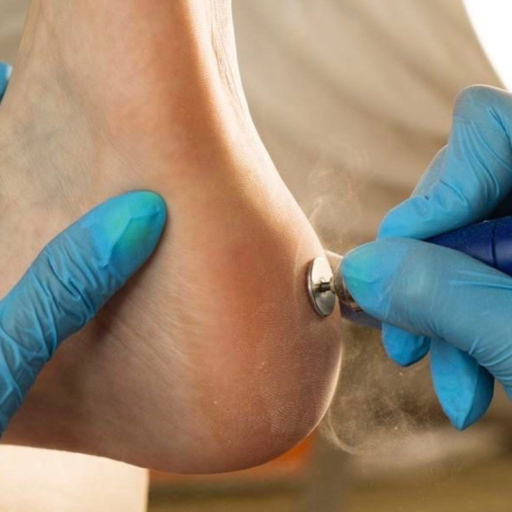 Smart обработка стоп