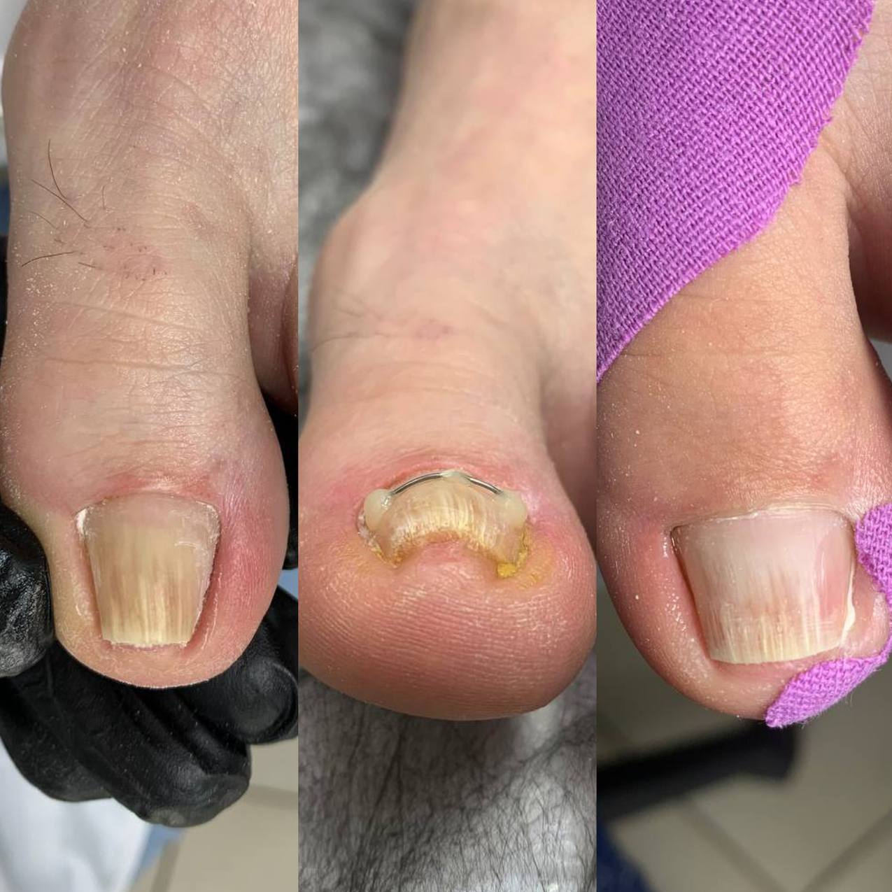 Коррекция вросшего ногтя «Титановая Нить»