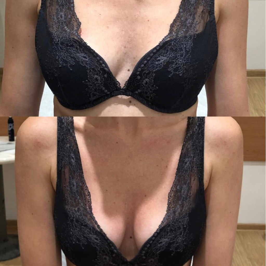 ЛИПОЛИФТИНГ ГРУДИ