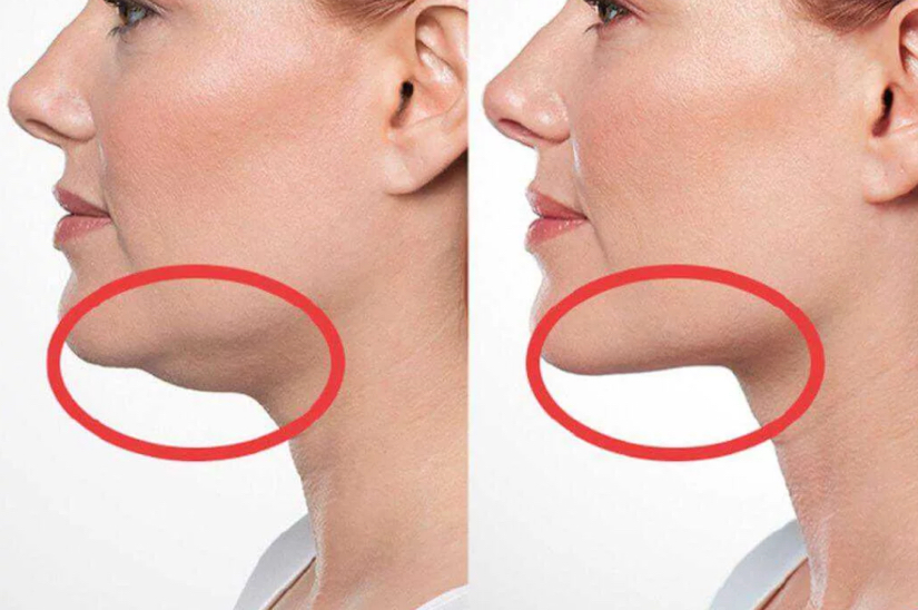 Рф-лифтинг лица