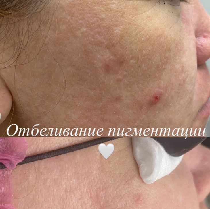 Отбеливание пигментации