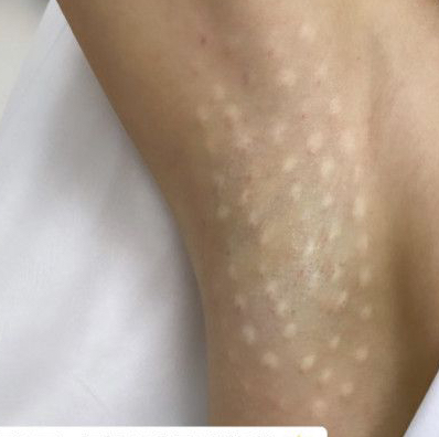 Гипергидроз