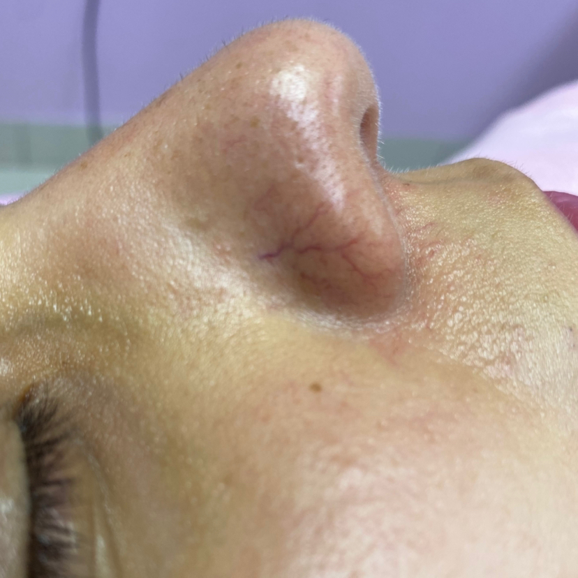 Лечение купероза